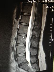 Herniated L5/S1.  Ouch.